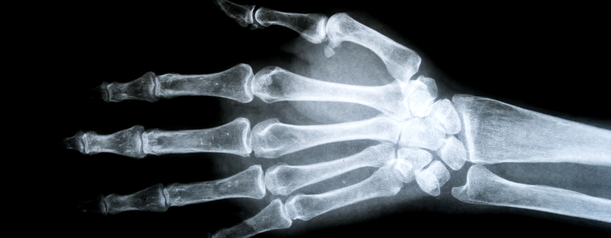 an x-ray of a hand